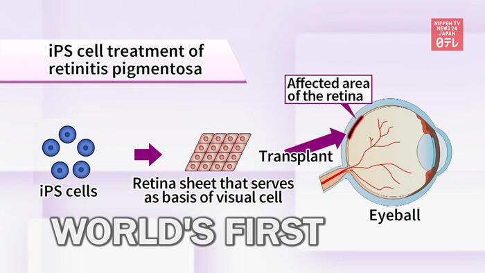 World's frst transplant of iPSi-derived retinal sheet in Japan