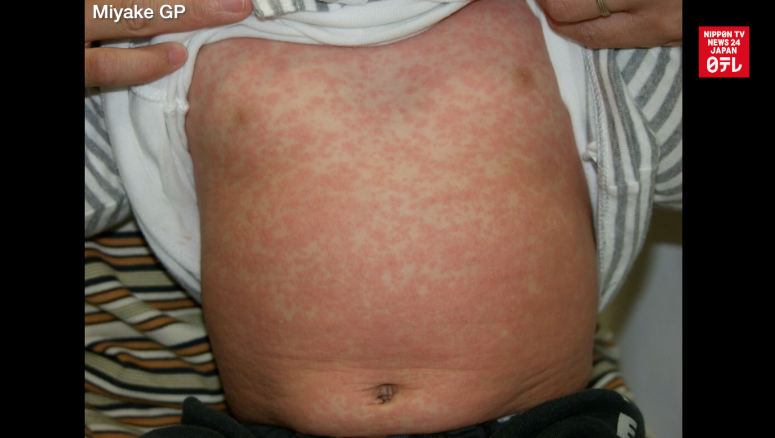 Measles outbreak hits Kansai airport