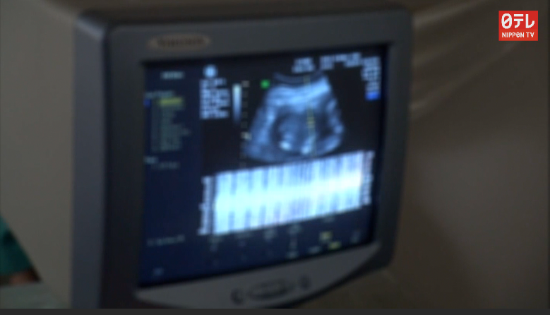 Japan's first fertilized eggs from anonymous donors