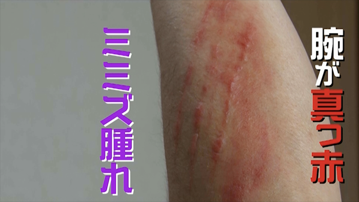 6 8月に激増 触れるだけで炎症を起こす危険な やけど虫 に注意 ザ 世界仰天ニュース 日本テレビ